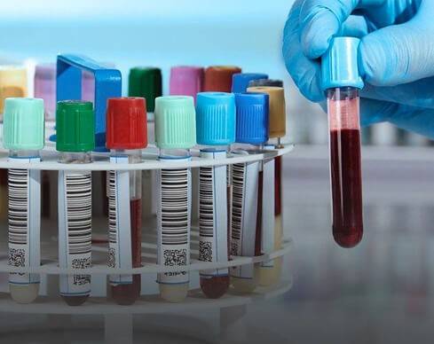 Blood vials in a rack.